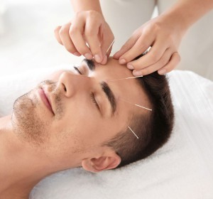 acupuncture